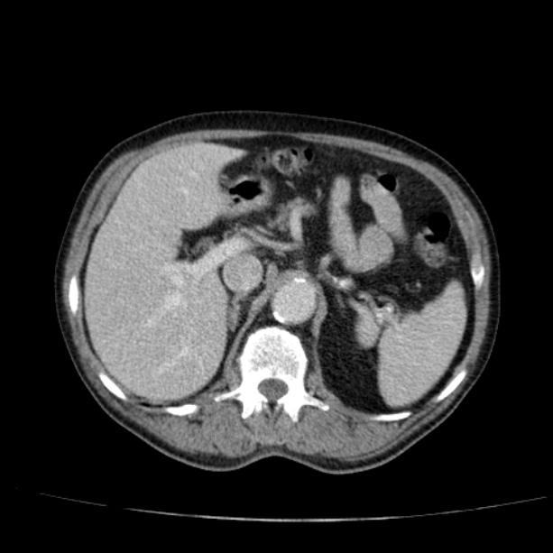 Abdominal aortic aneurysm (Radiopaedia 29248-29660 Axial C+ portal venous phase 18).jpg