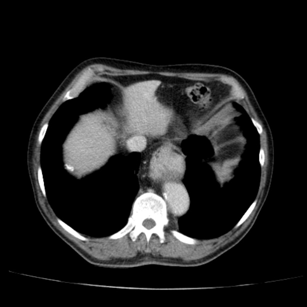 Abdominal aortic aneurysm (Radiopaedia 29248-29660 Axial C+ portal venous phase 9).jpg