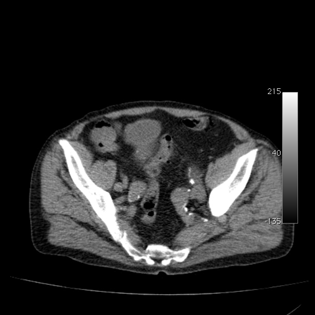 Abdominal aortic aneurysm (Radiopaedia 29248-29660 Axial non-contrast 47).jpg