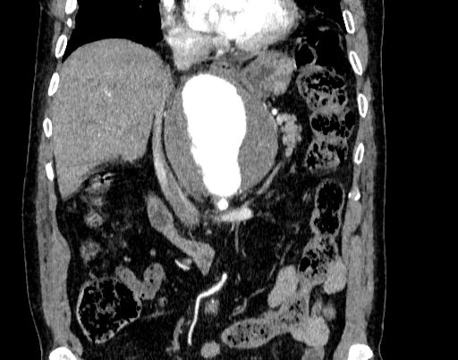 File:Abdominal aortic aneurysm (Radiopaedia 67117-76452 Coronal C+ arterial phase 41).jpg