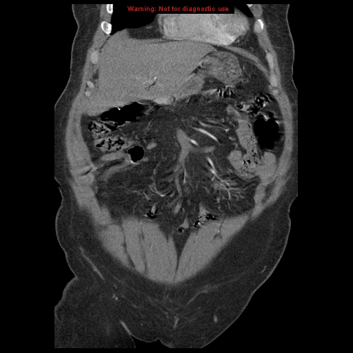 Abdominal aortic aneurysm (Radiopaedia 8190-9038 Coronal C+ arterial phase 29).jpg