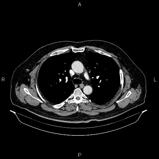File:Abdominal aortic aneurysm (Radiopaedia 83094-97462 Axial renal cortical phase 30).jpg