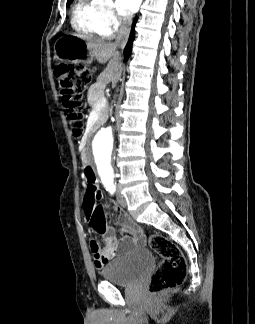 Abdominal aortic aneurysm (Radiopaedia 83581-98689 Sagittal C+ arterial phase 39).jpg