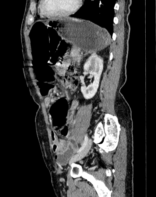 Abdominal aortic aneurysm (Radiopaedia 83581-98689 Sagittal C+ portal venous phase 88).jpg