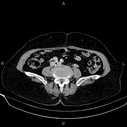 Abdominal aortic aneurysm (Radiopaedia 85063-100606 Axial C+ delayed 88).jpg