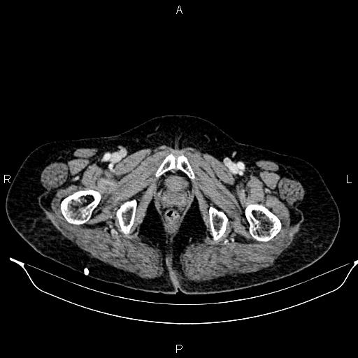 File:Abdominal aortic aneurysm (Radiopaedia 85063-100606 Axial C+ portal venous phase 67).jpg