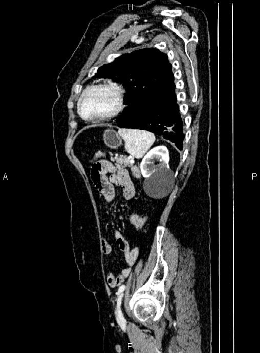 Abdominal aortic aneurysm (Radiopaedia 85063-100606 Sagittal C+ arterial phase 64).jpg