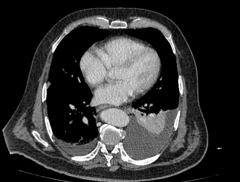 Abdominal aortic aneurysm rupture (Radiopaedia 54179-60362 Axial C+ portal venous phase 40).jpg