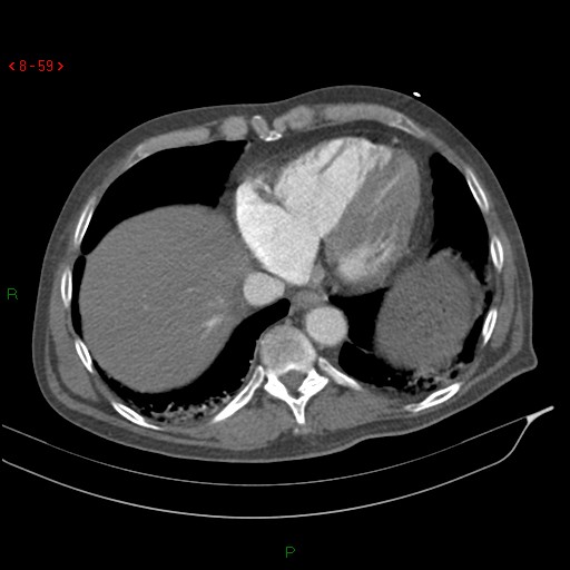 Abdominal aortic aneurysm rupture with aortocaval fistula (Radiopaedia 14897-14841 Axial C+ arterial phase 59).jpg