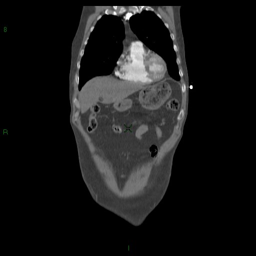 File:Abdominal aortic aneurysm rupture with aortocaval fistula (Radiopaedia 14897-14841 Coronal C+ arterial phase 17).jpg