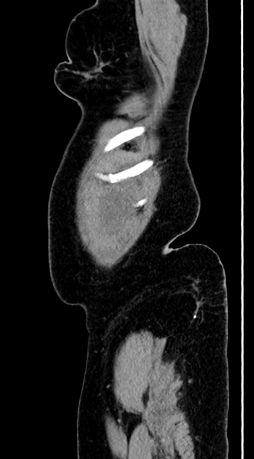 Abdominal hydatid disease (Radiopaedia 68223-77737 Sagittal C+ portal venous phase 70).jpg