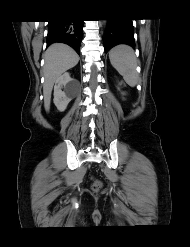 Abdominal lymphoma - with sandwich sign (Radiopaedia 53486-59492 C+ portal venous phase 12).jpg