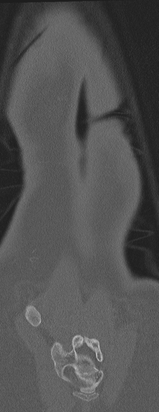 Abdominal multi-trauma - devascularised kidney and liver, spleen and pancreatic lacerations (Radiopaedia 34984-36486 Coronal bone window 70).png