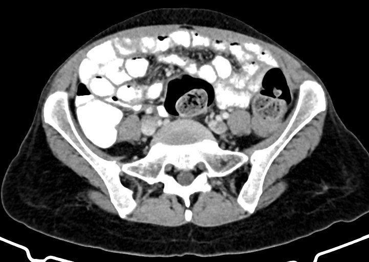 File:Abdominal wall and retroperitoneal tuberculosis (Radiopaedia 88137-104729 Axial C+ portal venous phase 131).jpg