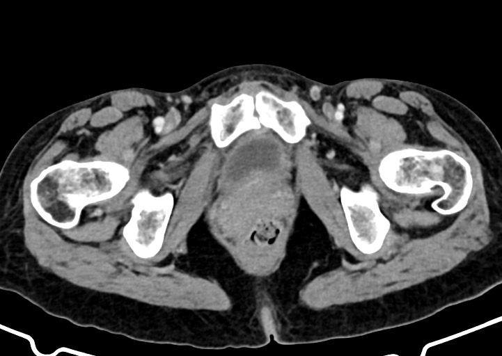 Abdominal wall and retroperitoneal tuberculosis (Radiopaedia 88137-104729 Axial C+ portal venous phase 192).jpg