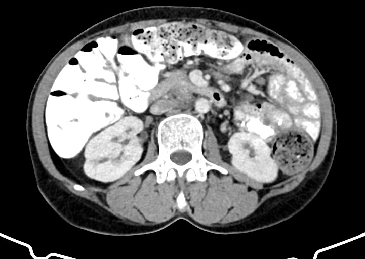 Abdominal wall and retroperitoneal tuberculosis (Radiopaedia 88137-104729 Axial C+ portal venous phase 87).jpg