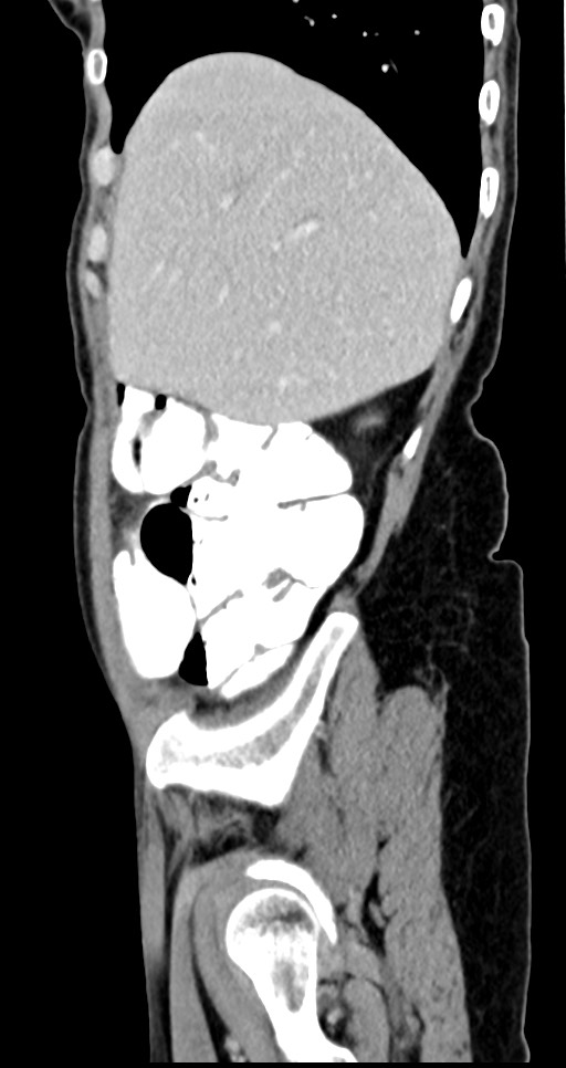 Abdominal wall and retroperitoneal tuberculosis (Radiopaedia 88137-104729 Sagittal C+ portal venous phase 121).jpg