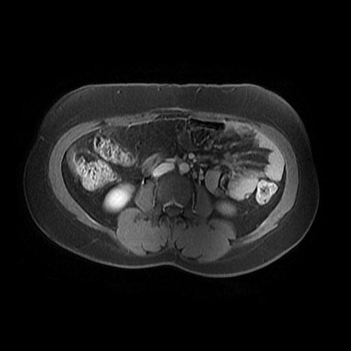 File:Abdominal wall endometriosis (Radiopaedia 83702-98847 Axial T1 C+ fat sat 6).jpg