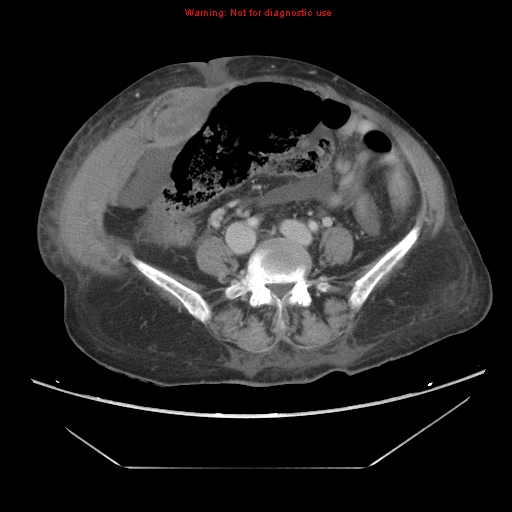 File:Abdominal wall hematoma (Radiopaedia 9427-10112 Axial C+ portal venous phase 70).jpg