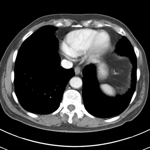 Abdominal wall metastasis from colorectal carcinoma (Radiopaedia 31016-31717 Axial C+ portal venous phase 10).jpg