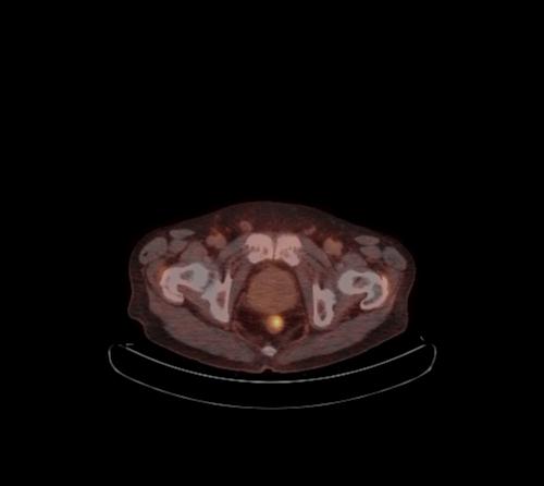 File:Abdominal wall metastasis from colorectal carcinoma (Radiopaedia 31016-31719 C 22).jpg