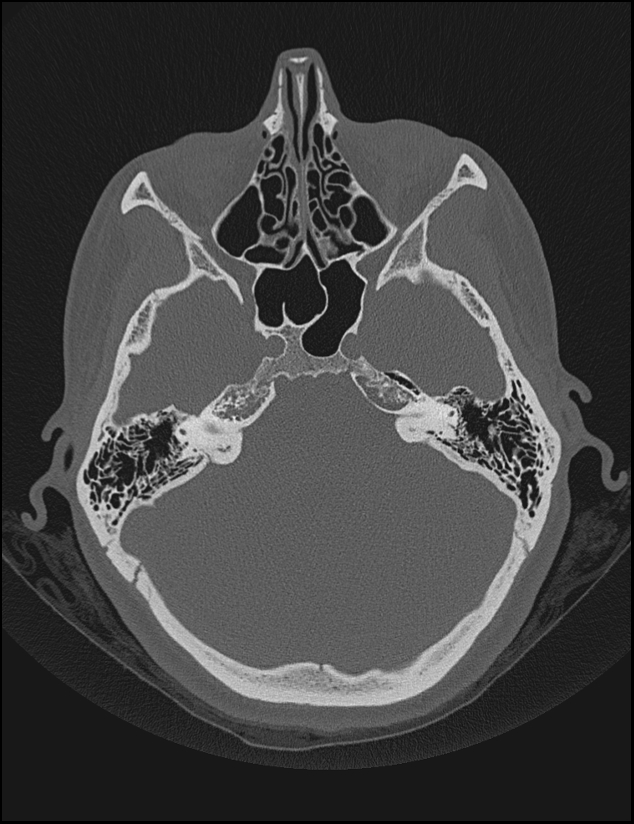 Aberrant right internal carotid artery (Radiopaedia 65191-74198 Axial non-contrast 51).jpg