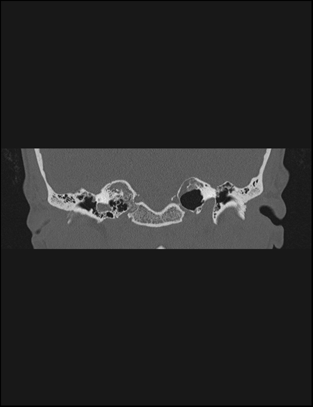 Aberrant right internal carotid artery (Radiopaedia 65191-74198 Coronal non-contrast 36).jpg