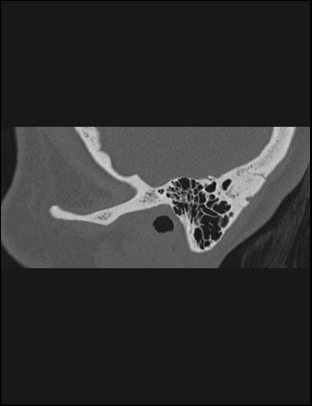 Aberrant right internal carotid artery (Radiopaedia 65191-74198 Sagittal non-contrast 18).jpg