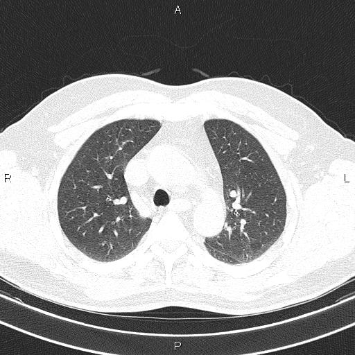Aberrant right subclavian artery (Radiopaedia 87093-103354 Axial lung window 35).jpg