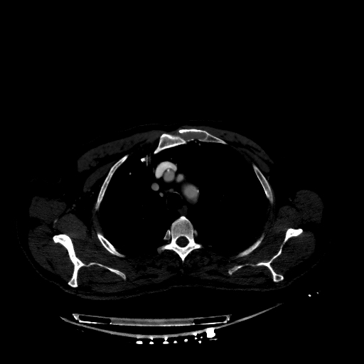 Accesory rib joint (Radiopaedia 71987-82452 Axial bone window 73).jpg
