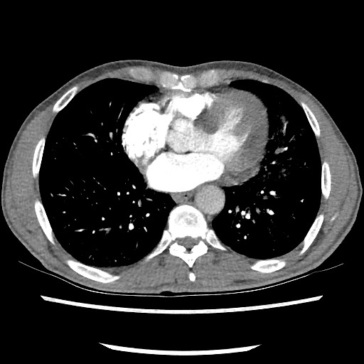 Accessory left horizontal fissure with lingular pneumonia (Radiopaedia 53763-59843 Axial C+ CTPA 61).jpg