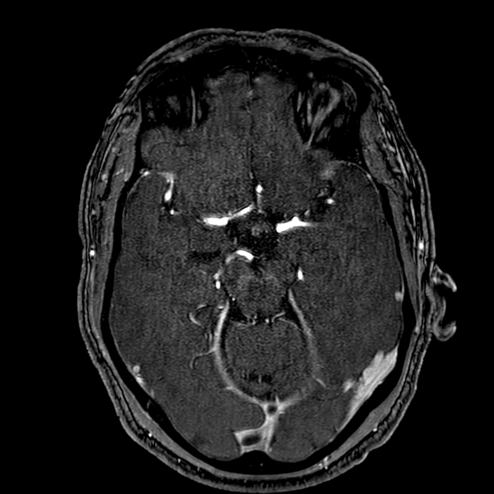 Accessory middle cerebral artery (Radiopaedia 73114-83828 Axial MRA 73).jpg