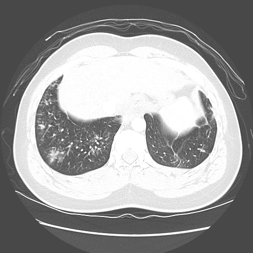 Achalasia (Radiopaedia 52507-58417 Axial lung window 54).jpg