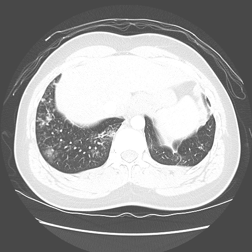 Achalasia (Radiopaedia 52507-58417 Axial lung window 55).jpg