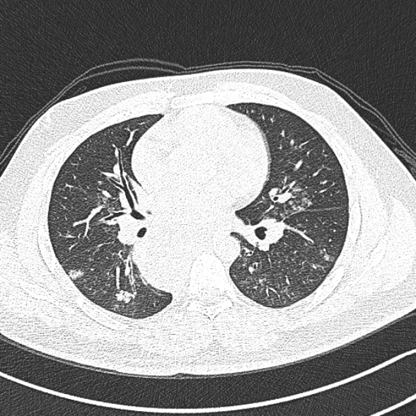 Achalasia with aspiration (Radiopaedia 55413-61845 Axial lung window 38).jpg