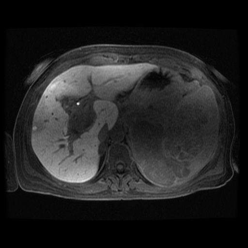 Acinar cell carcinoma of the pancreas (Radiopaedia 75442-86668 Axial late phase (~30 mins) 95).jpg