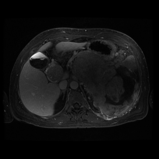 Acinar cell carcinoma of the pancreas (Radiopaedia 75442-86668 D 80).jpg
