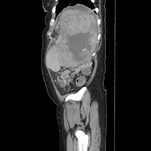 Acinar cell carcinoma of the pancreas (Radiopaedia 75442-86669 Sagittal C+ portal venous phase 161).jpg