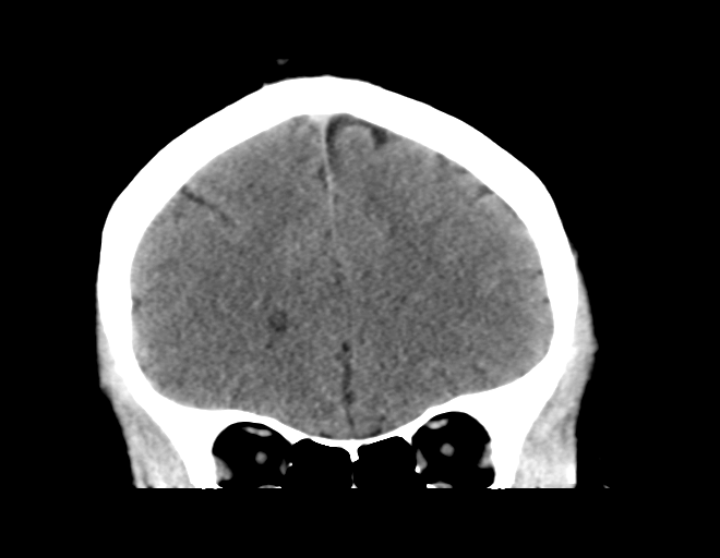 File:Acoustic schwannoma (Radiopaedia 33045-34065 Coronal non-contrast 15).png