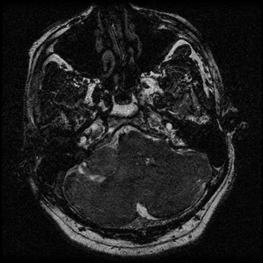 File:Acoustic schwannoma (Radiopaedia 39170-41387 Axial FIESTA 49).png