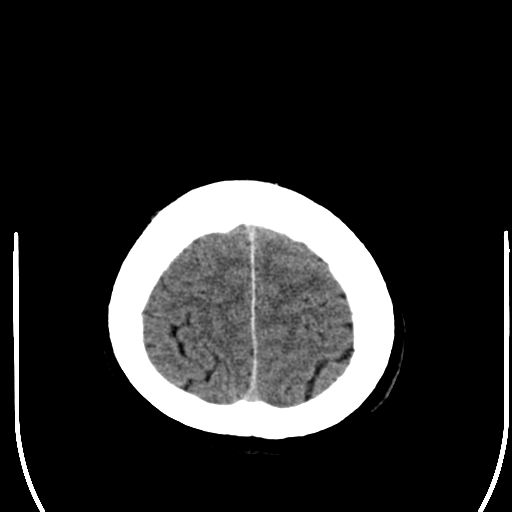 File:Acoustic schwannoma (Radiopaedia 39170-41389 Axial non-contrast 26).png
