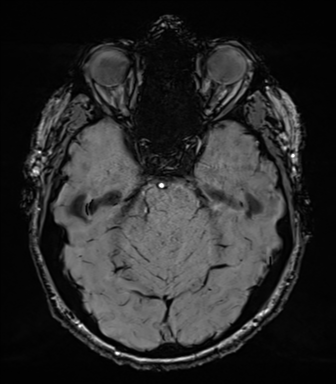 File:Acoustic schwannoma (Radiopaedia 50846-56358 Axial SWI 31).png