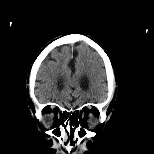 File:Acoustic schwannoma (Radiopaedia 55729-62280 Coronal non-contrast 11).png