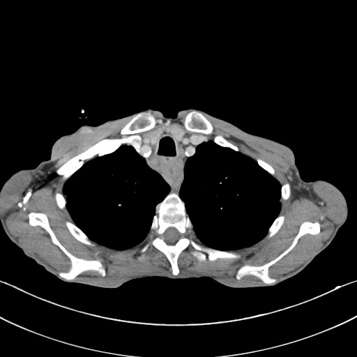 File:Acquired tracheoesophageal fistula (Radiopaedia 57747-65042 Axial C+ portal venous phase 17).jpg