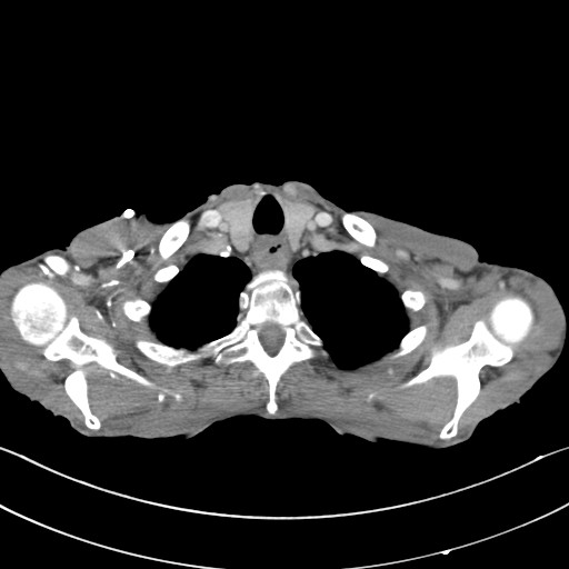 File:Acquired tracheoesophageal fistula (Radiopaedia 57747-65042 Axial C+ portal venous phase 8).jpg