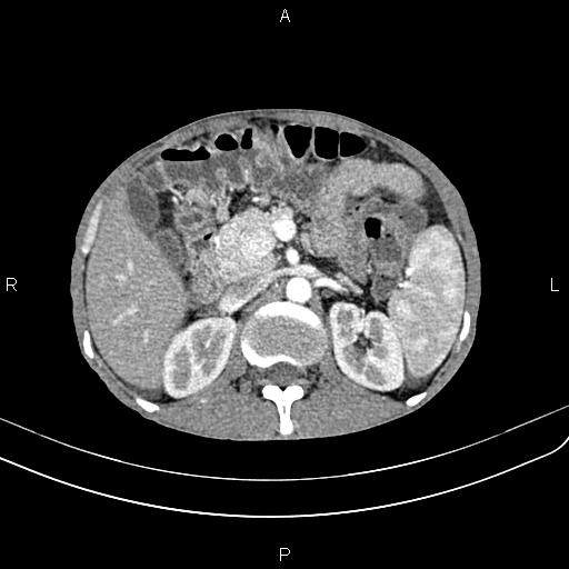 Active crohn disease (Radiopaedia 87133-103397 Axial C+ arterial phase 37).jpg