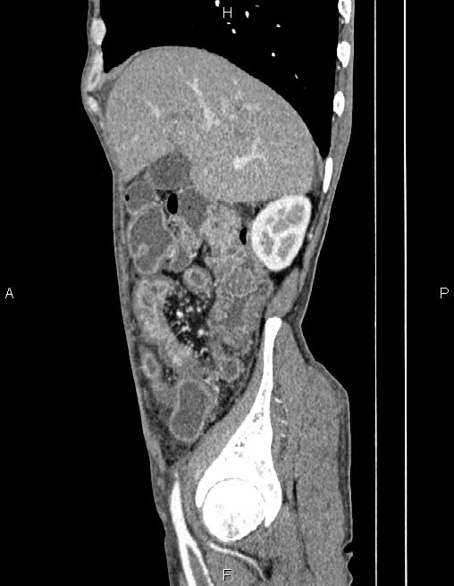 Active crohn disease (Radiopaedia 87133-103397 Sagittal C+ arterial phase 19).jpg