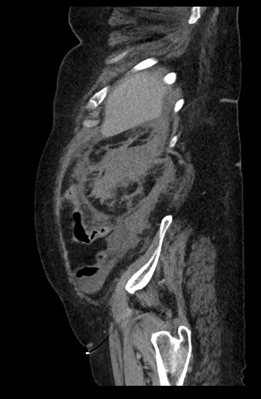 Active renal extravasation with large subcapsular and retroperitoneal hemorrhage (Radiopaedia 60975-68796 Sagittal C+ portal venous phase 57).jpg
