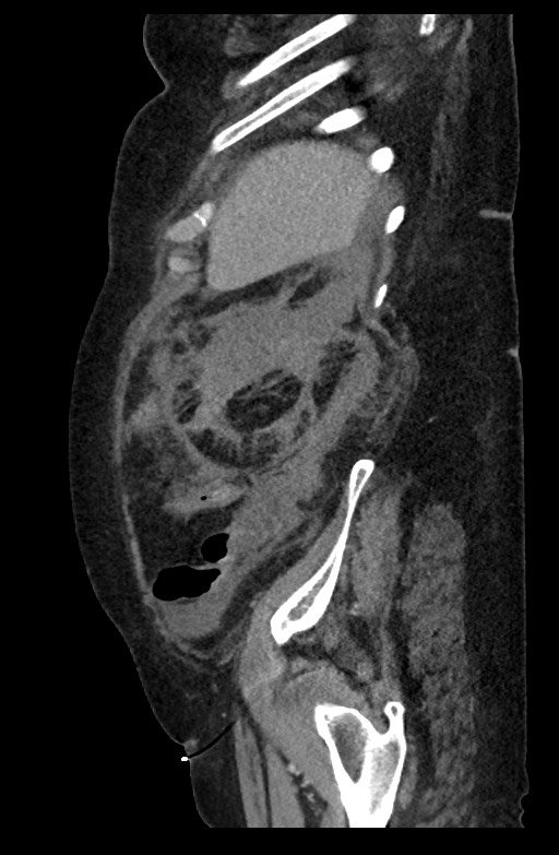 Active renal extravasation with large subcapsular and retroperitoneal hemorrhage (Radiopaedia 60975-68796 Sagittal C+ portal venous phase 59).jpg