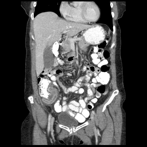 Acute appendicitis (Radiopaedia 52672-58589 Coronal C+ portal venous phase 25).jpg